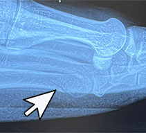 5th Metatarsal Bone Fracture