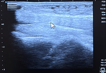 Healthy Posterior Tibial Tendon Ultrasound-1