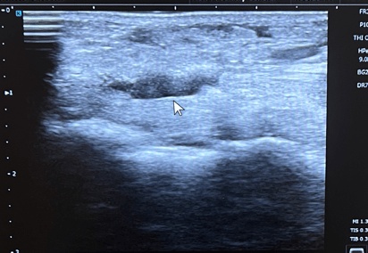 Posterior Tibial Tendon Tear Ultrasound