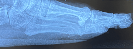 Stress Fracture