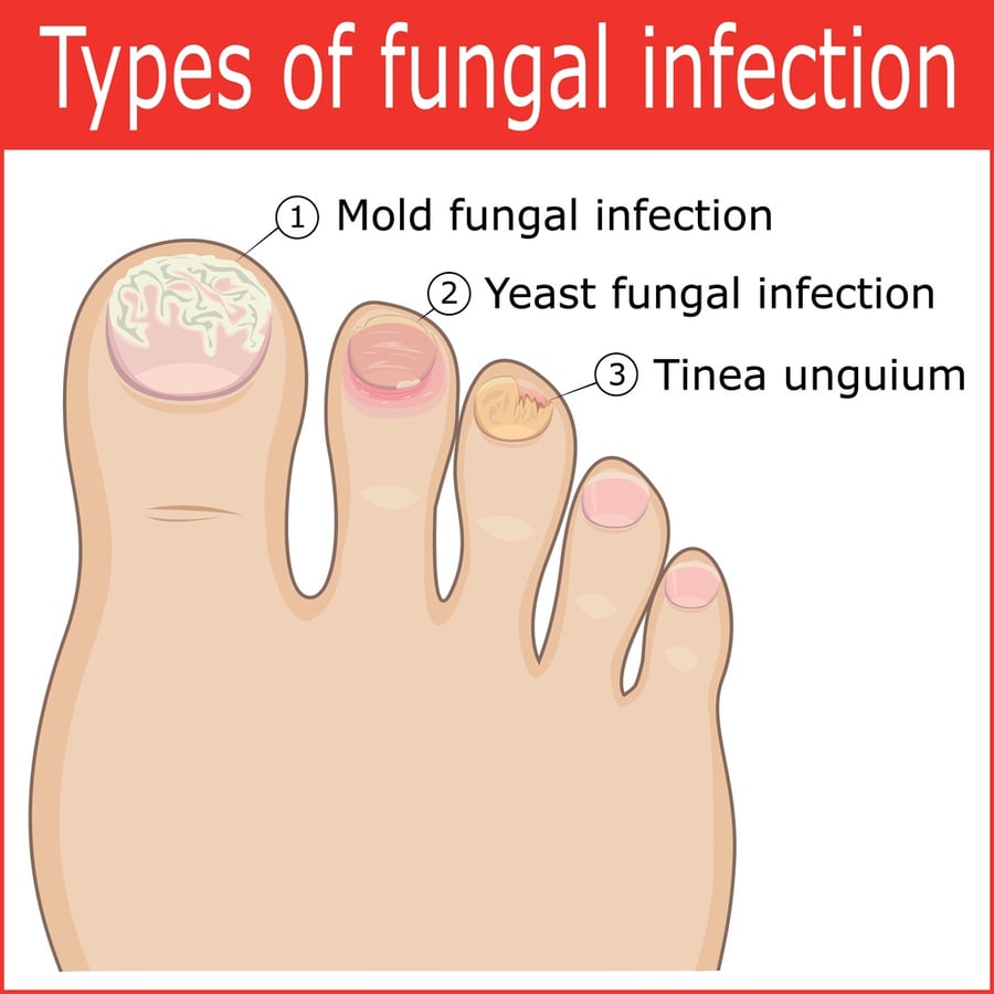 Toe Pain And Discolored toenails