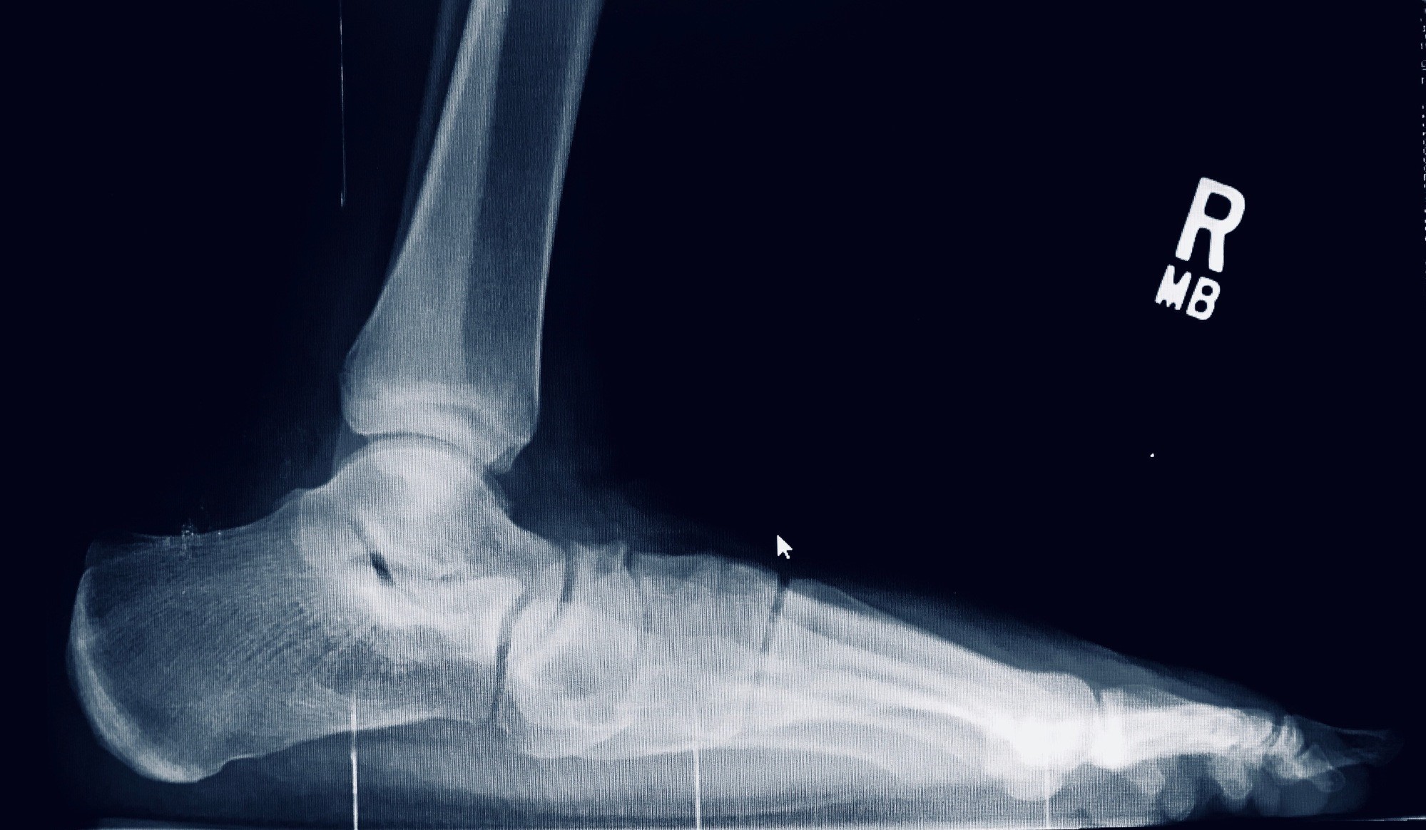 Flat Foot Pre-Op Reconstructive Surgery