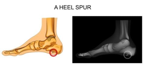 Plantar Fasciitis, Heel Spur - Texas Foot Surgeons