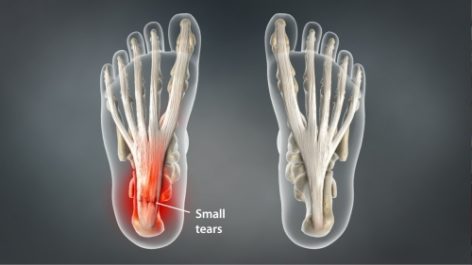 Heel pain anatomy. | Download Scientific Diagram