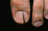 Podiatric Skin Conditions