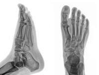 Closed Fractures and Sprains of the Foot and Ankle